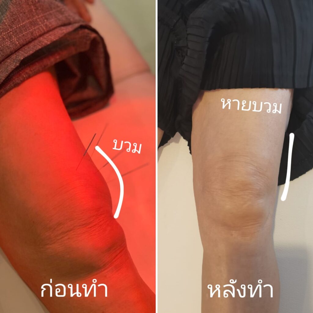 พิมพ์สบันงาคลินิก ฝังเข็ม ครอบแก้ว ยาจีน